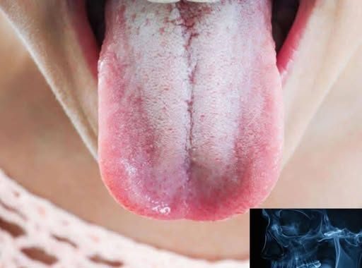 🚨😥If your tongue is white, this is a clear sign that you are suffering from…see more