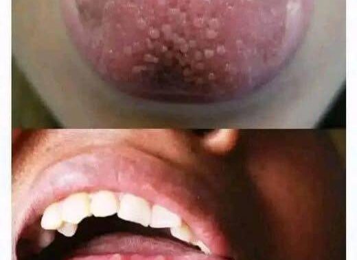😱If you have these little balls on your tongue, worry, it’s a sign of… See more