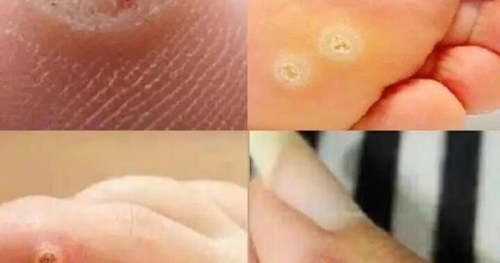 Be Very Careful: If You Notice This Skin Growth, It Could Be Serious