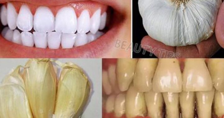 Improve Your Oral Health Naturally with Garlic